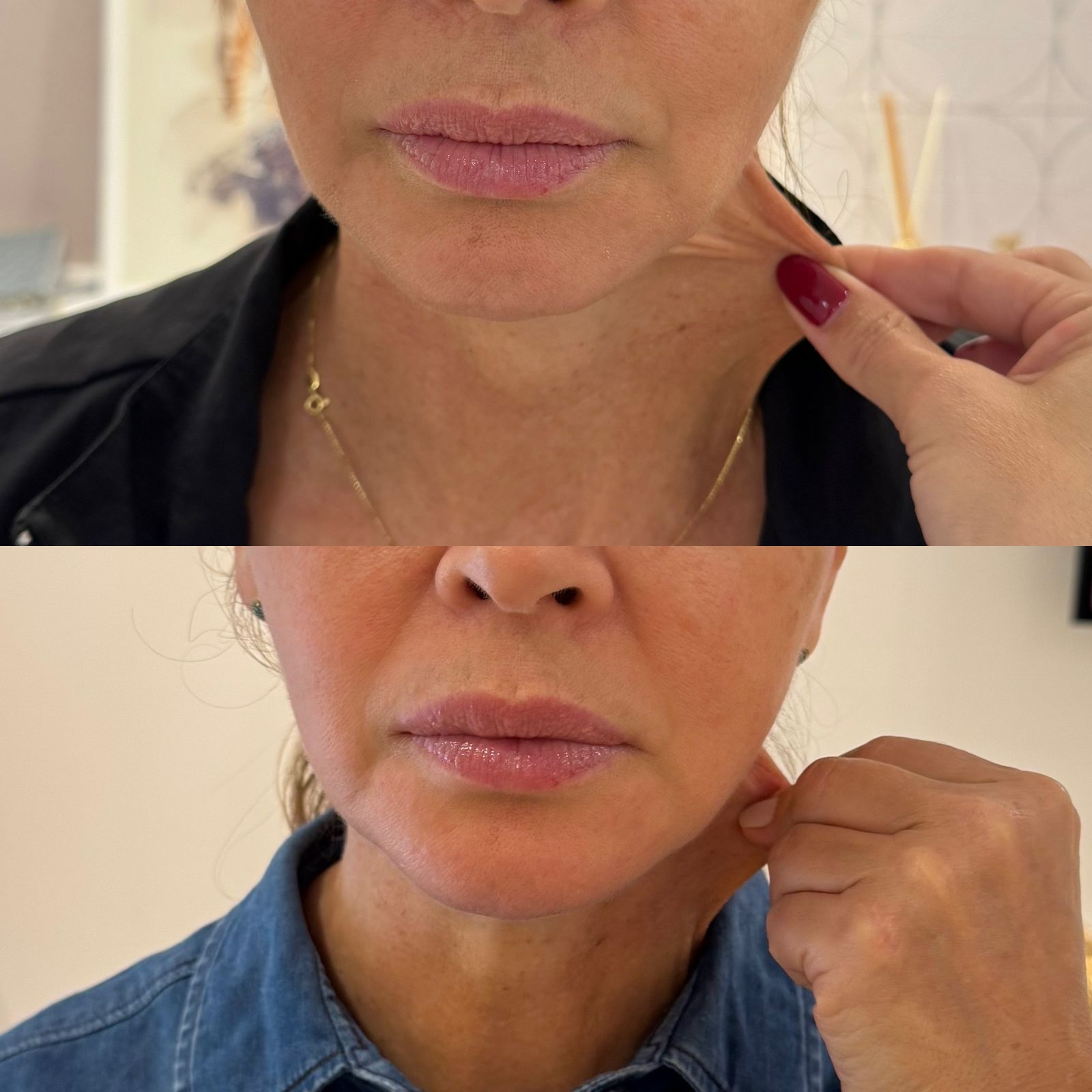 FLACIDEZ PESCOÇO DZORZI 01