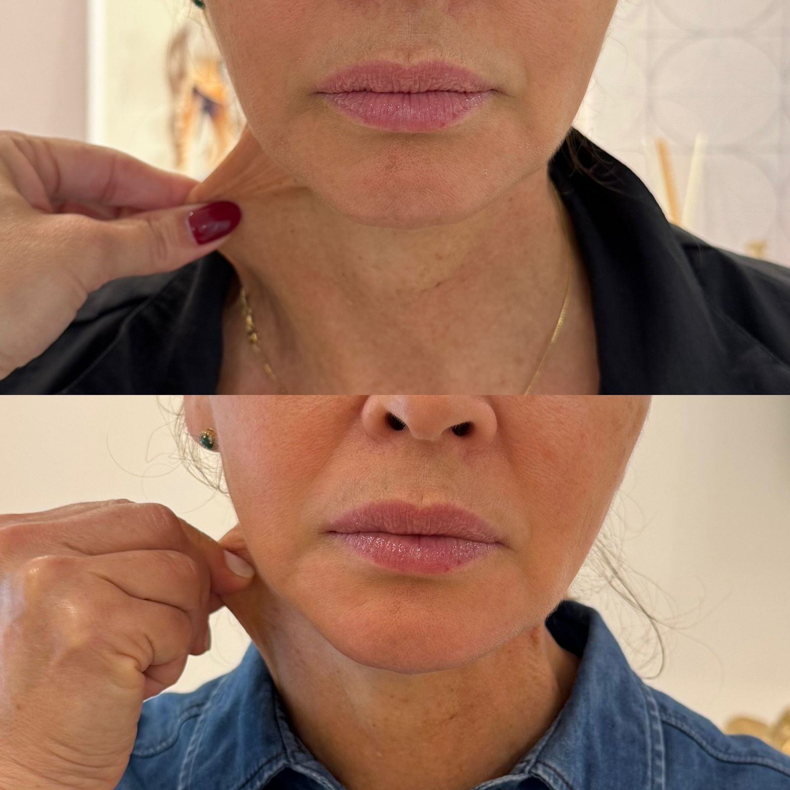 FLACIDEZ PESCOÇO DZORZI 02