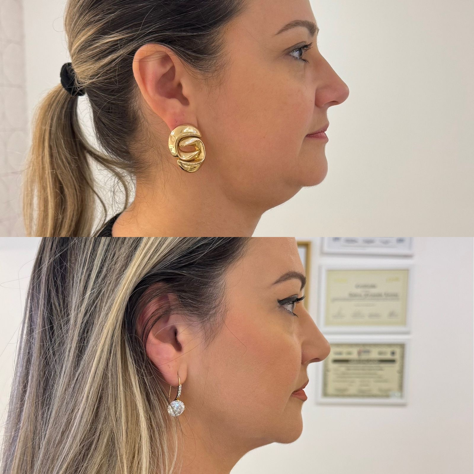 PAPADA-ULTRAFORMER-DZORZI.2