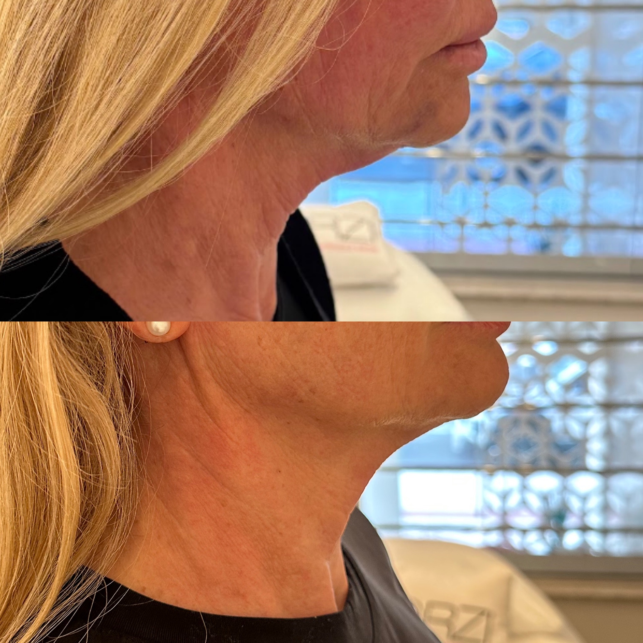 PAPADA-ULTRAFORMER-DZORZI.4