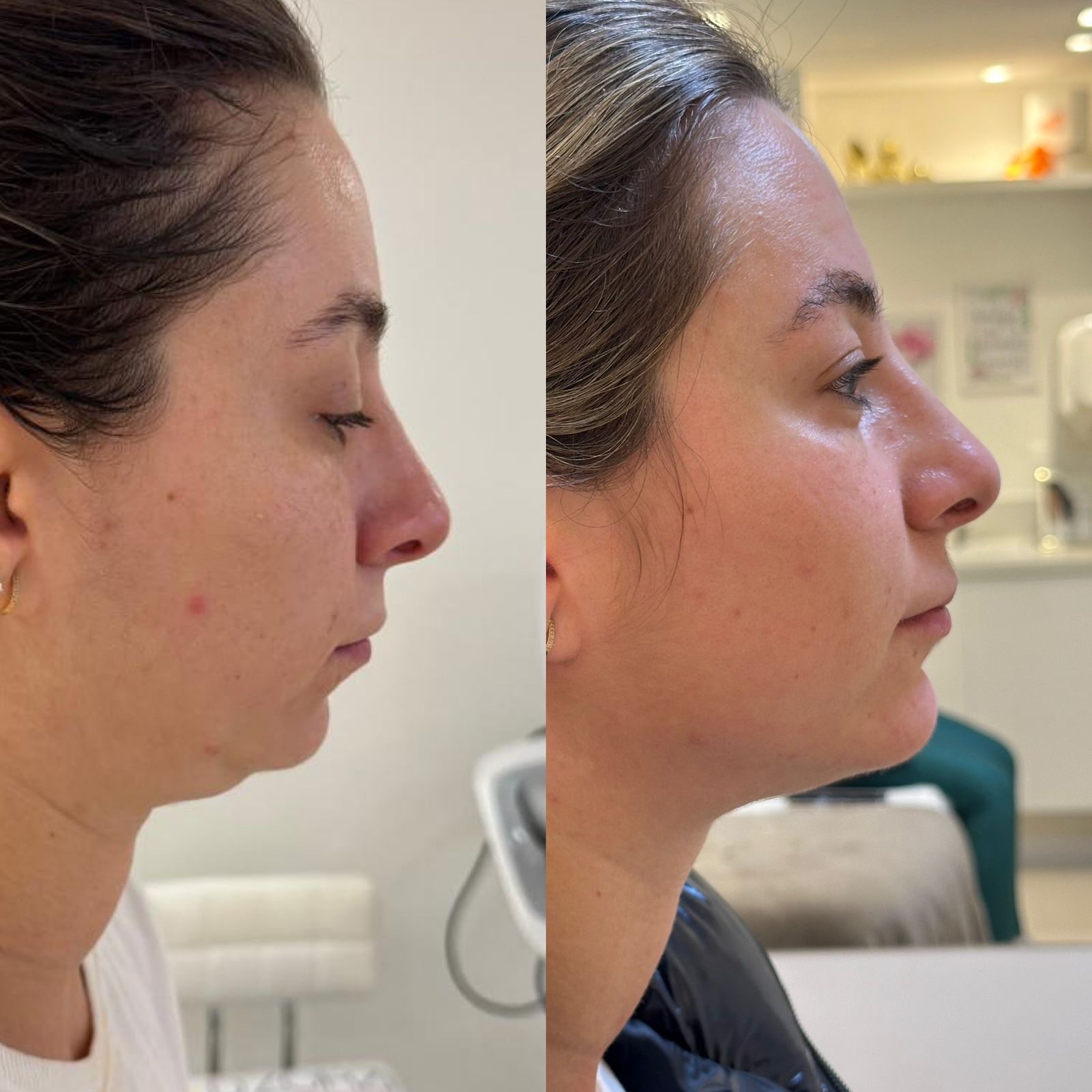 PAPADA-ULTRAFORMER-DZORZI.5