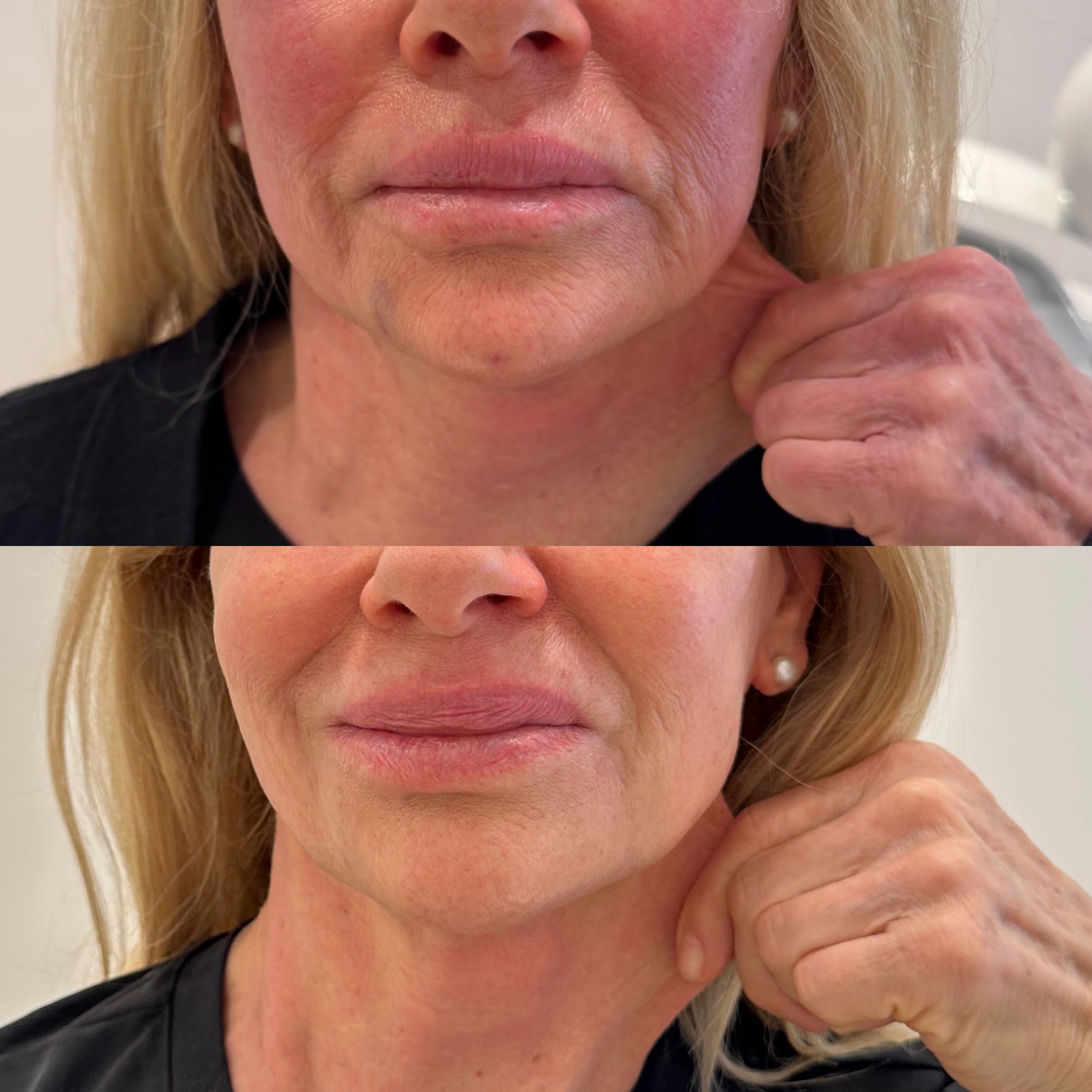 PESCOÇO ULTRAFORMER.1