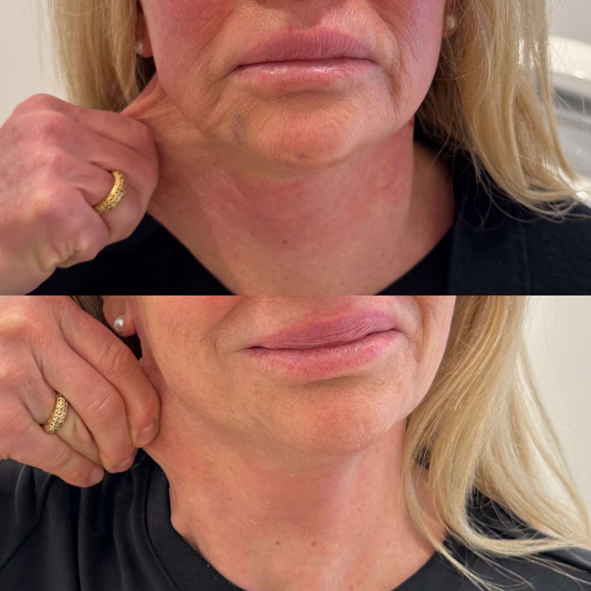 PESCOÇO ULTRAFORMER.2