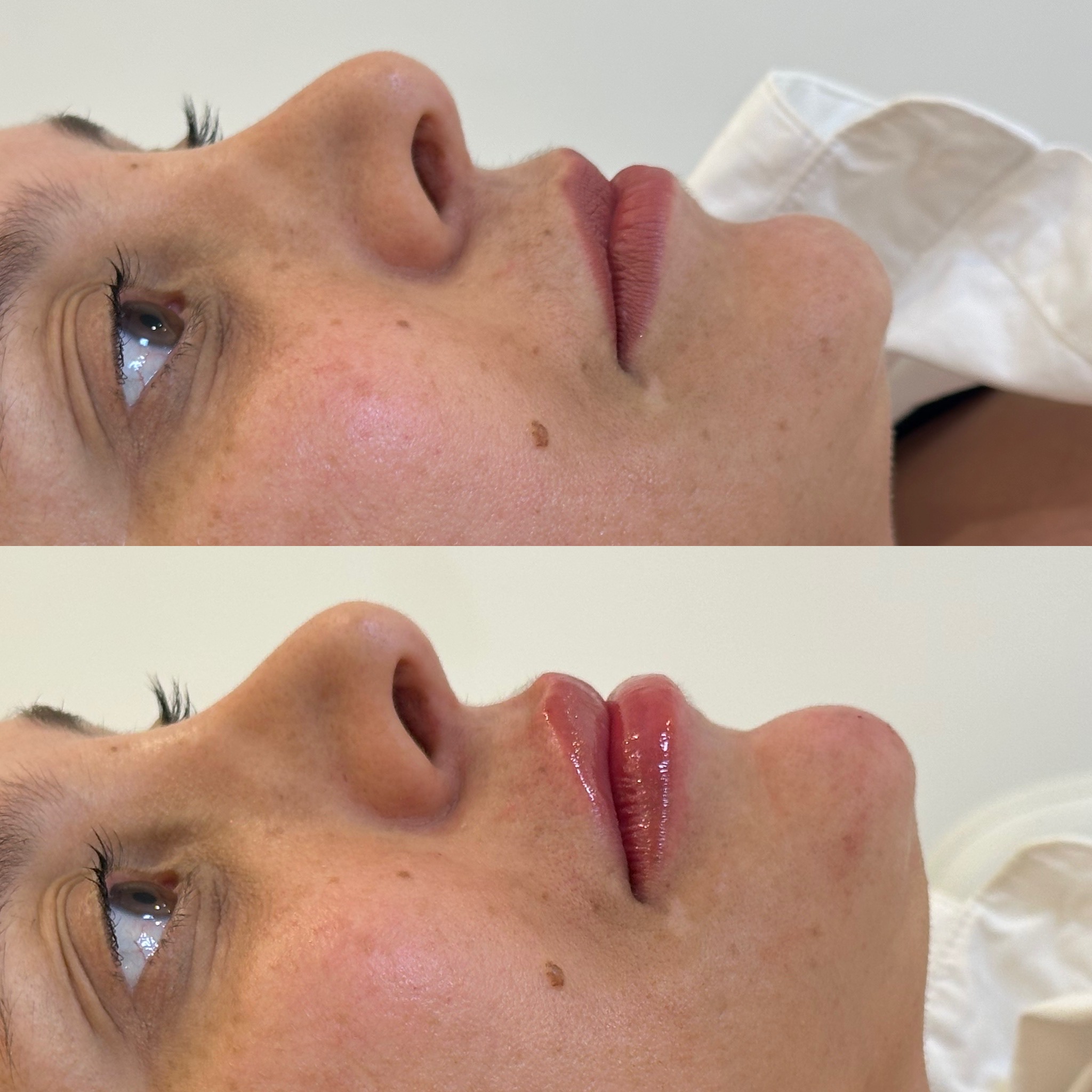 PREENCHIMENTO LABIAL-DZORZI