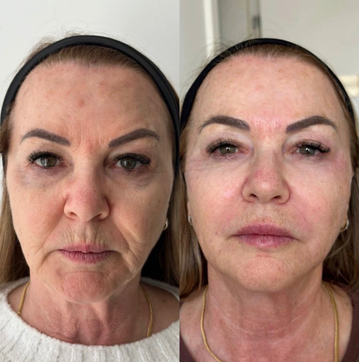 ULTRAFORMER DZORZI 01