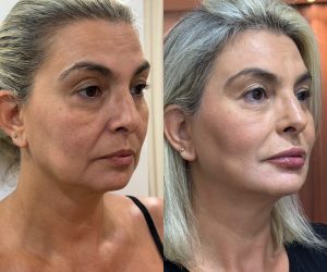 HARMONIZAÇÃO FACIAL